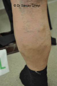 Results after Foam Sclerotherapy
